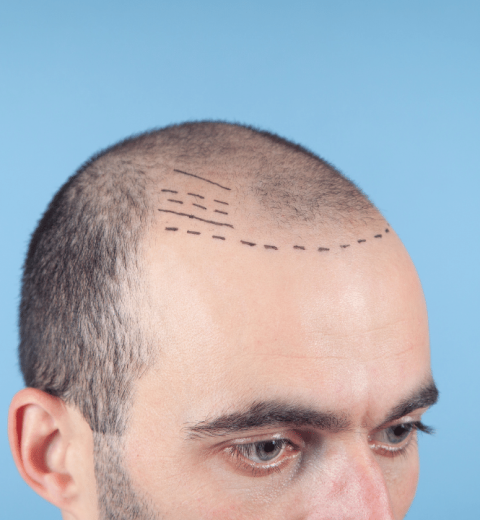 5 Key Factors to Consider Before Choosing a Hair Transplant Clinic in Turkey
