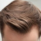 How to Have Best Hair Transplant in Istanbul?