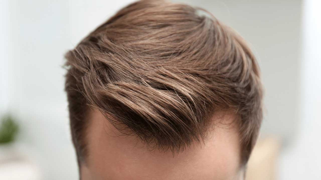 Maximizing Your Results: Tips for the Best Hair Transplant Outcome