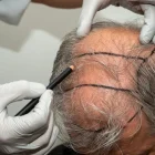 FUE vs. DHI – Which Hair Transplant Technique is Best for You?